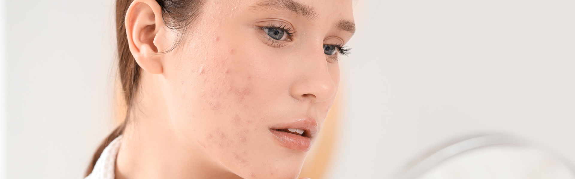 The connection between spots and gut health: Sarah’s story