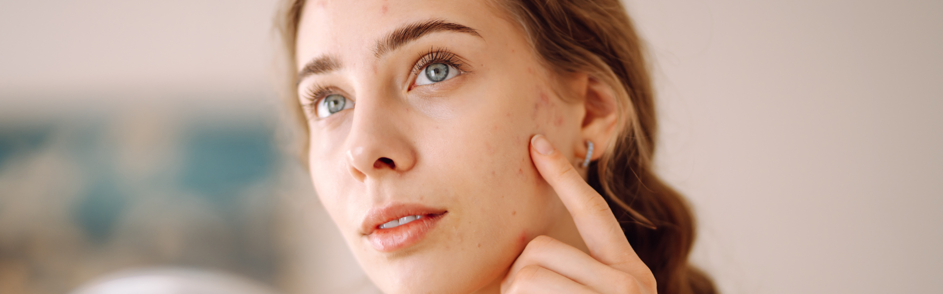 Understanding acne and its causes