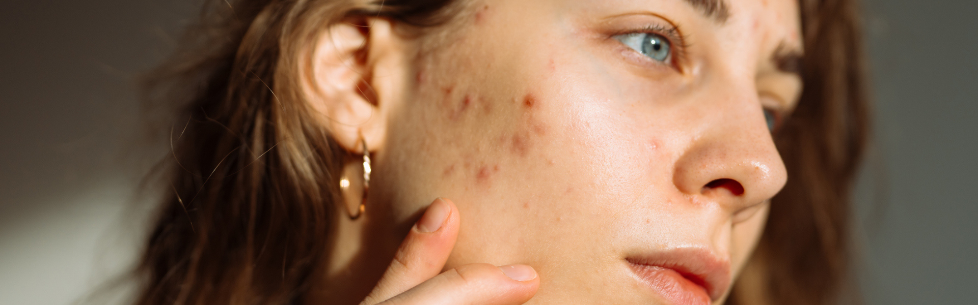 Stress and Skin : Why Do My Skin Issues Keep Coming Back?
